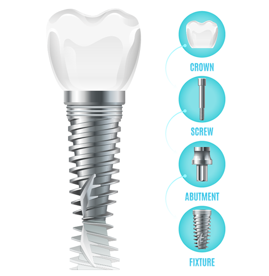 Dental Health Implant